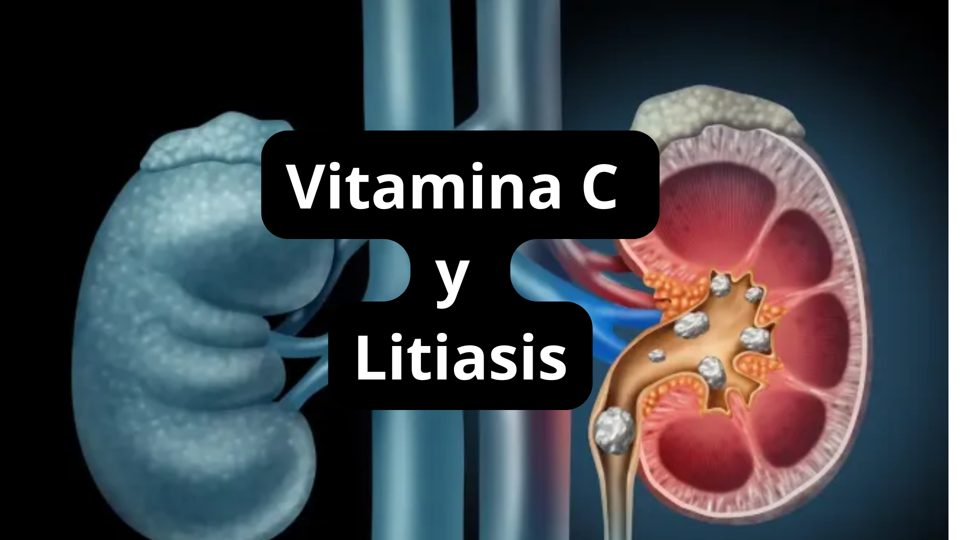 Vitamina C y Litiasis